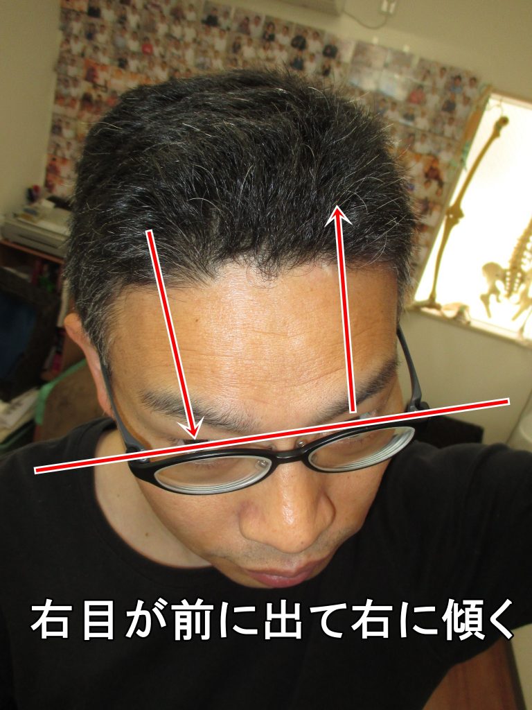 右目が前に出て右に傾く