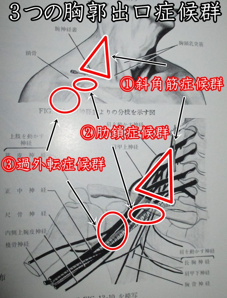 胸郭出口症候群