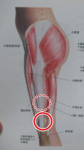 大腿筋膜張筋腸脛靭帯炎つまむ場所
