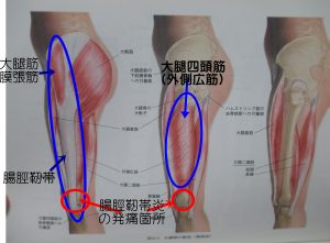 腸脛靭帯炎と筋肉解剖