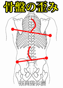 骨盤の歪み
